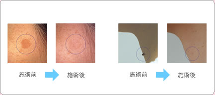 施術前/施術後